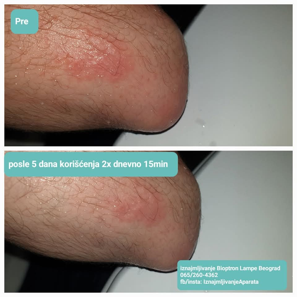 Bioptron lampa problemi sa kozom pre i posle bioptron pro 1 iskustva korisnika iznajmljivanje rentiranje renta bioptrona beograd