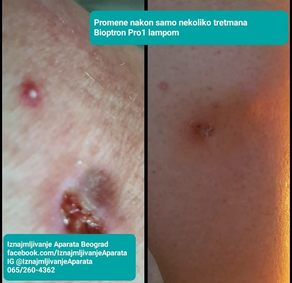 bioptron svetlosna terapija pre i posle problemi na kozi iskustva koristnika iznajmljivanje iznajmljivanja bioptron lampe beograd